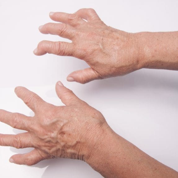Rheumatoid Hands