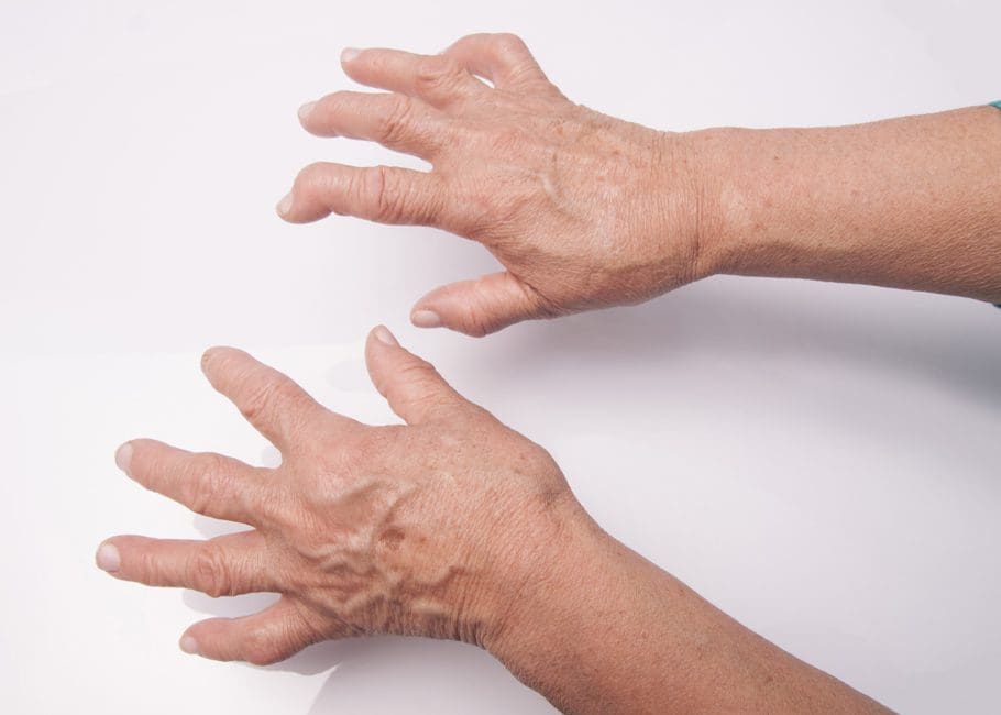 Rheumatoid Hands