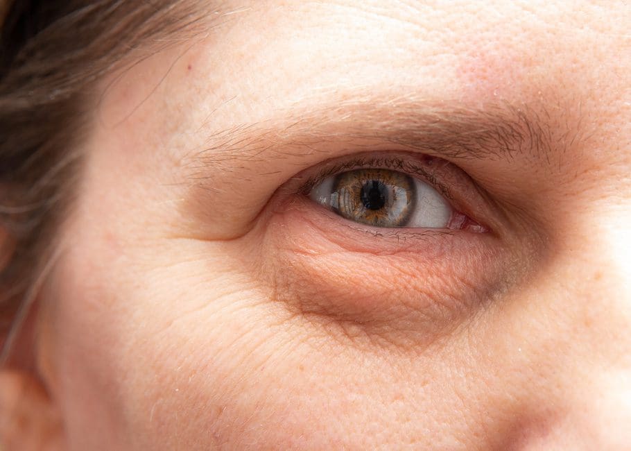 Upper Eyelid Excess / Droopy Eyelids